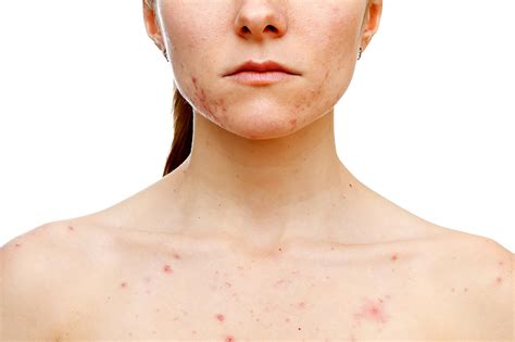 Chest Acne: What Causes It and How to Get Rid of It | The Healthy