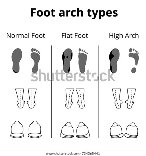 Foot Arch Types Vector Icons Set Stock Vector (Royalty Free) 734365441