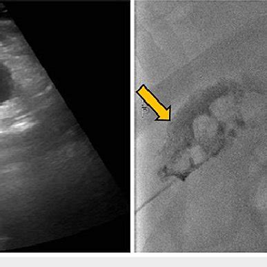 Fluoroscopic image-guided percutaneous cholecystostomy tube placement ...