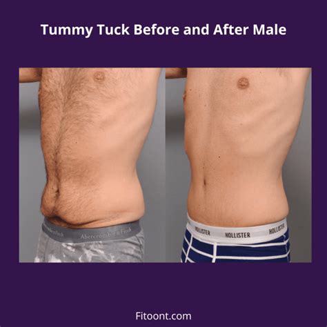 Tummy Tuck Before and After Male Tips and Recovery - Fitoont