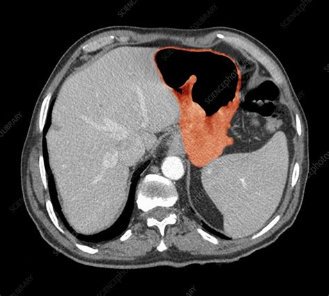 Stomach cancer, CT scan - Stock Image C021/3036 - Science Photo Library