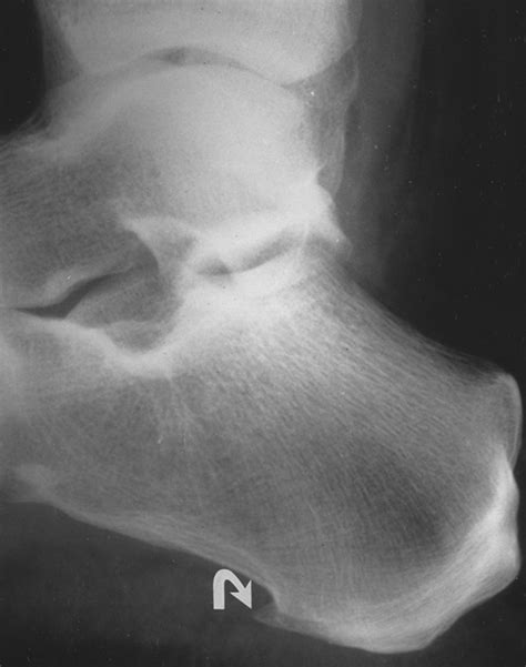 Disorders of the Plantar Aponeurosis A Spectrum of MR Imaging Findings | AJR