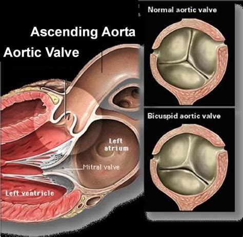 Bicuspid aortic valve disease – Artofit