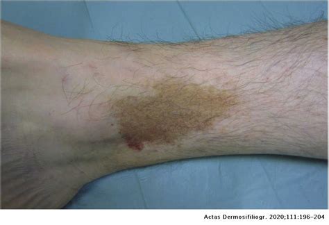 Pigmented Purpuric Dermatosis: A Review of the Literature | Actas Dermo-Sifiliográficas