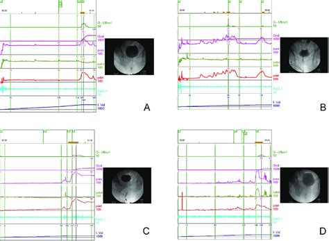 The videourodynamic tracings in men with (A) a stable bladder with... | Download Scientific Diagram