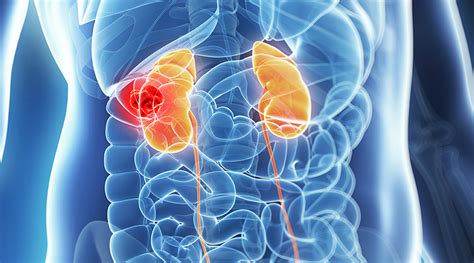 Adjuvant pembrolizumab prolongs overall survival for kidney cancer ...