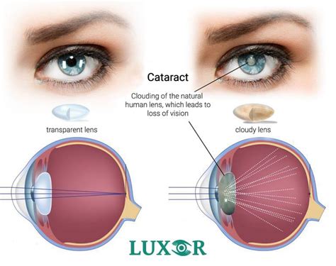 Cataract - causes, symptoms, treatment