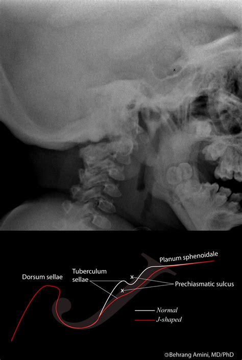 Tuberculum Sellae