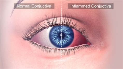 Allergic conjunctivitis: Symptoms, Types, Causes And Treatment