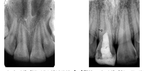 Table 1 from Mineral trioxide aggregate as a pulpotomy agent in immature teeth: Long-term case ...