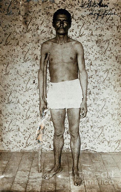 Dry Beriberi Patient Photograph by Wellcome Images/science Photo ...