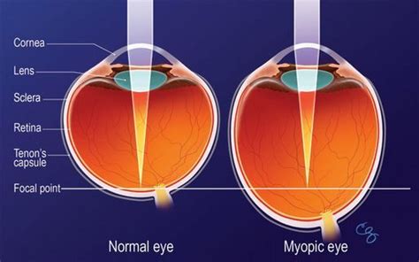 Lattice Degeneration & Retinal Detachment Risk - Preventative Treatment? - endmyopia.org