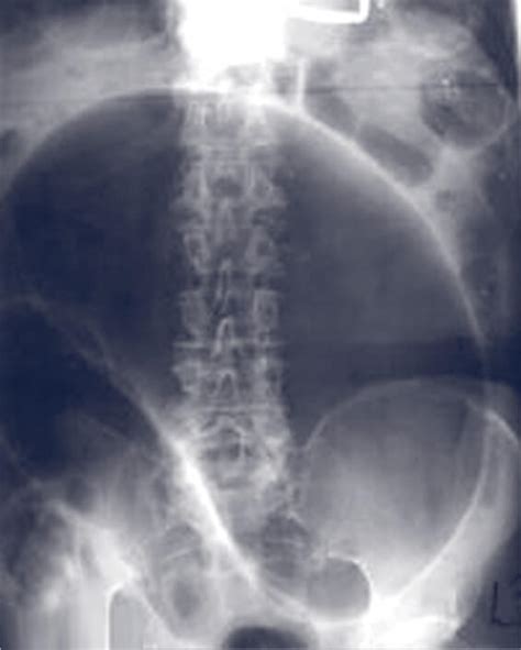 Colonic Volvulus | LA Colon & Rectal Surgical Associates