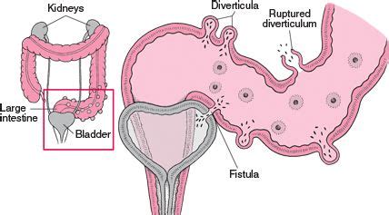 79 Best DIVERTICULOSIS VS. DIVERTICULITIS-HOW TO MANAGE DIET/FLAREUPS ...