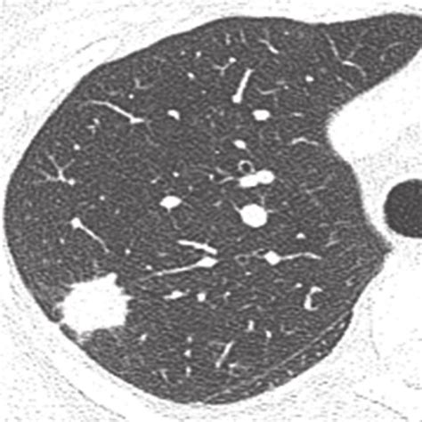 Causes of a solitary pulmonary nodule. | Download Table