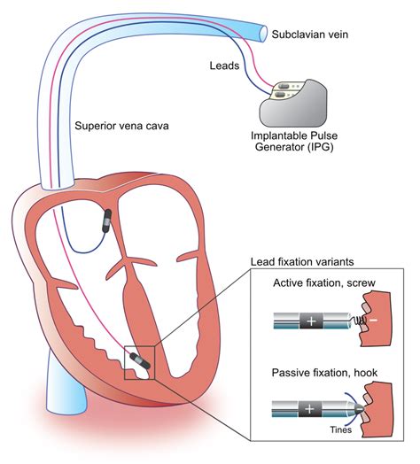 Components and construction of a pacemaker – Cardiovascular Education