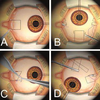 (PDF) Review: Minimally invasive strabismus surgery