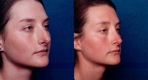 The Nose Clinic | BEFORE & AFTER NOSE SURGERY PHOTOS 57