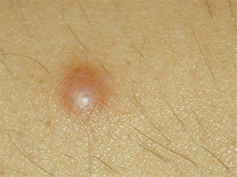 dermatofibromas images - pictures, photos