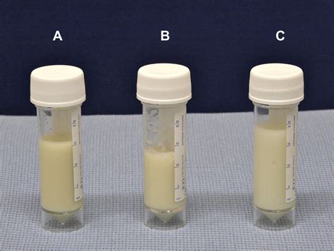 Thoracentesis Fluid