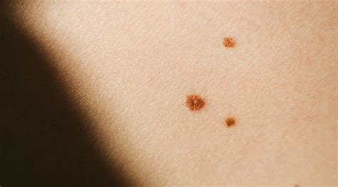 how does a cancerous mole look like | Symptoms and pictures