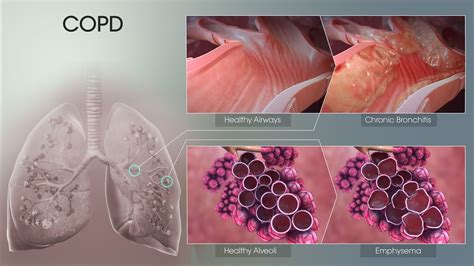 COPD - Chronic Obstructive Pulmonary Disease | Chronic Obstr… | Flickr