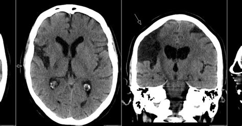 Radiology MRI: Wallerian Degeneration