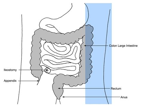 Ileostomy | UCSF Ostomy Education Portal