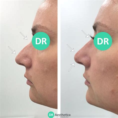 Bump on Nose Treatment Without Surgery - Dr Aesthetica