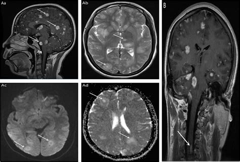 Toxoplasma Gondii Brain Abscess