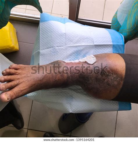 Chronic Venous Ulcer Patient Leg Clinical Stock Photo 1395164201 | Shutterstock