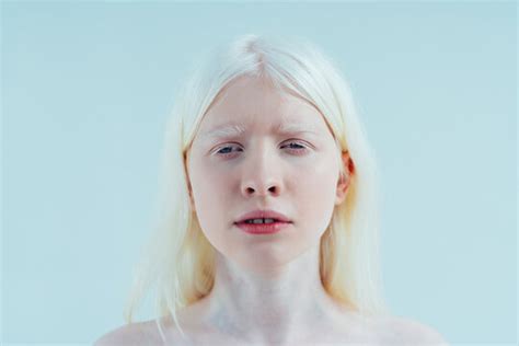 Albino Human