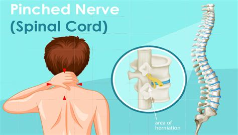 Pinched Nerve Pain Phoenix and Peoria | Haggard Chiropractic