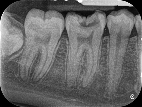 Periapical Radiograph Posterior