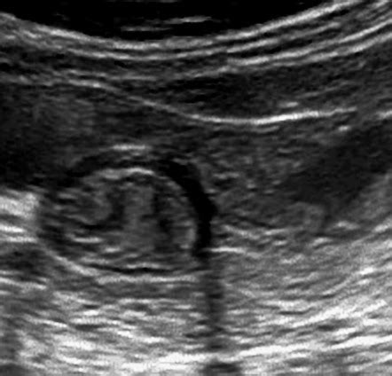 Small bowel (ultrasound) | Radiology Case | Radiopaedia.org