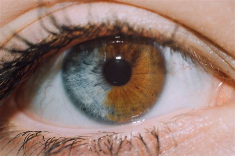 My friend's iris is split in half | Different colored eyes, Rare eye ...