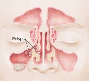 Nasal Polyps Treatment Without Surgery-NaturalCure openzimzim.com