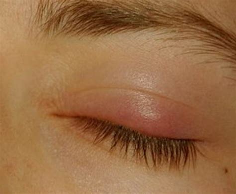 Bump on Eyelid - Symptoms, Causes, Treatment, Pictures