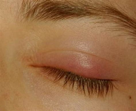 Bump on Eyelid - Symptoms, Causes, Treatment, Pictures