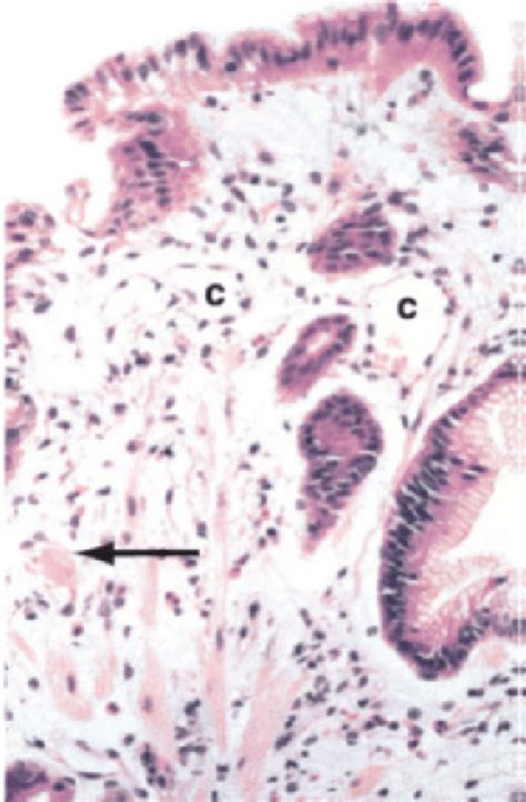 Gastric antral vascular ectasia (GAVE). Histology shows dilated... | Download Scientific Diagram