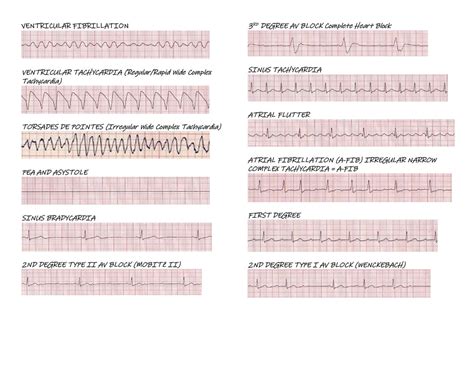 Different Types Of Ekg Rhythms - vrogue.co