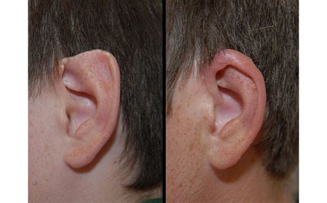 Ear Surgery Gallery | St. Louis Children's Hospital