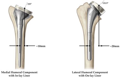 JFMK | Free Full-Text | Reverse Shoulder Arthroplasty Biomechanics