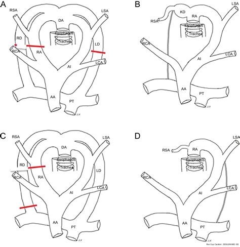 Right Aortic Arch With Aberrant Left Subclavian