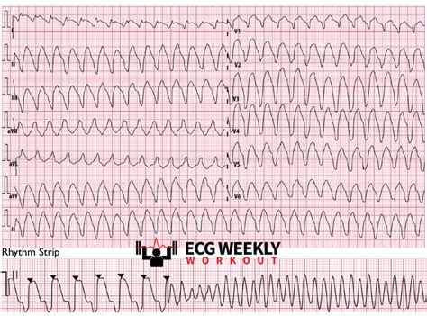 STAT ECG Diagnoses: ventricular fibrillation after synchronized cardioversion for a regular wide ...