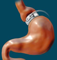 Adjustable gastric band - Wikipedia, the free encyclopedia