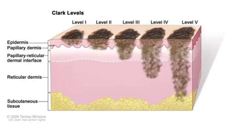 Melanoma: Causas, Sintomas e Tratamento - Clínica Dra. Juliana Toma