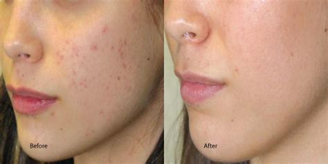 Chemical-Peel-Acne-Redondo-Beach - Aesthetic Dermatology & Dermatologic Surgery Center