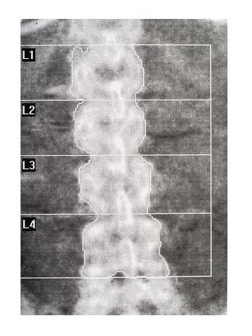 Bone Density Dexa Scan Osteoporosis Diagnosis Stock Photo - Download ...