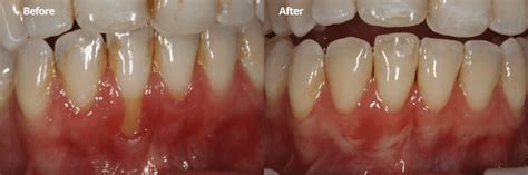 Dental Images Before and After in Indianapolis, IN | Sonrisa Dental